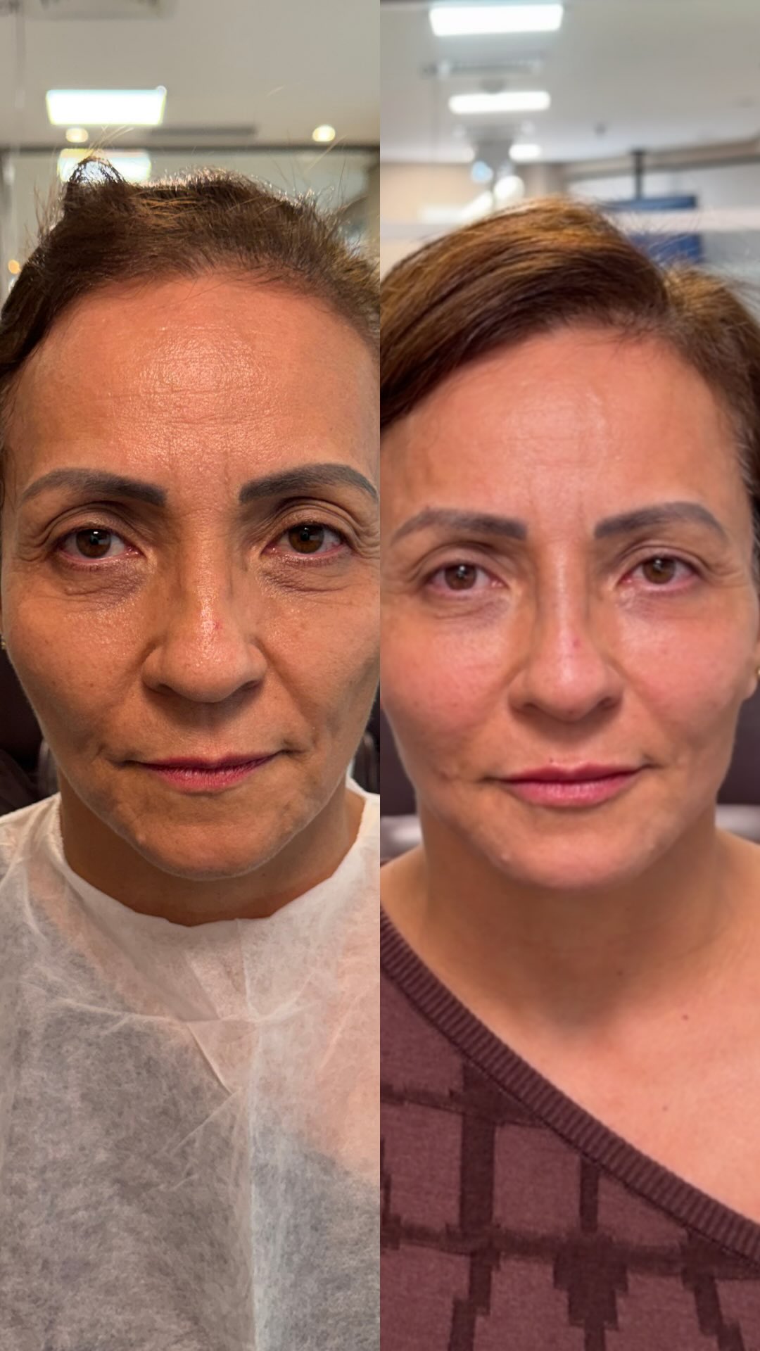 Antes e depois — resultado real 2 de harmonização facial