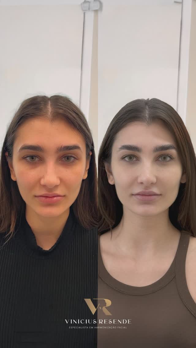 Antes e depois — resultado real 3 de harmonização facial